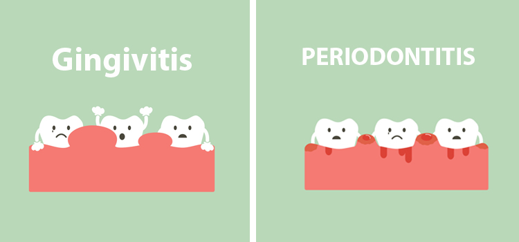 Gingivitis Vs Periodontitis
